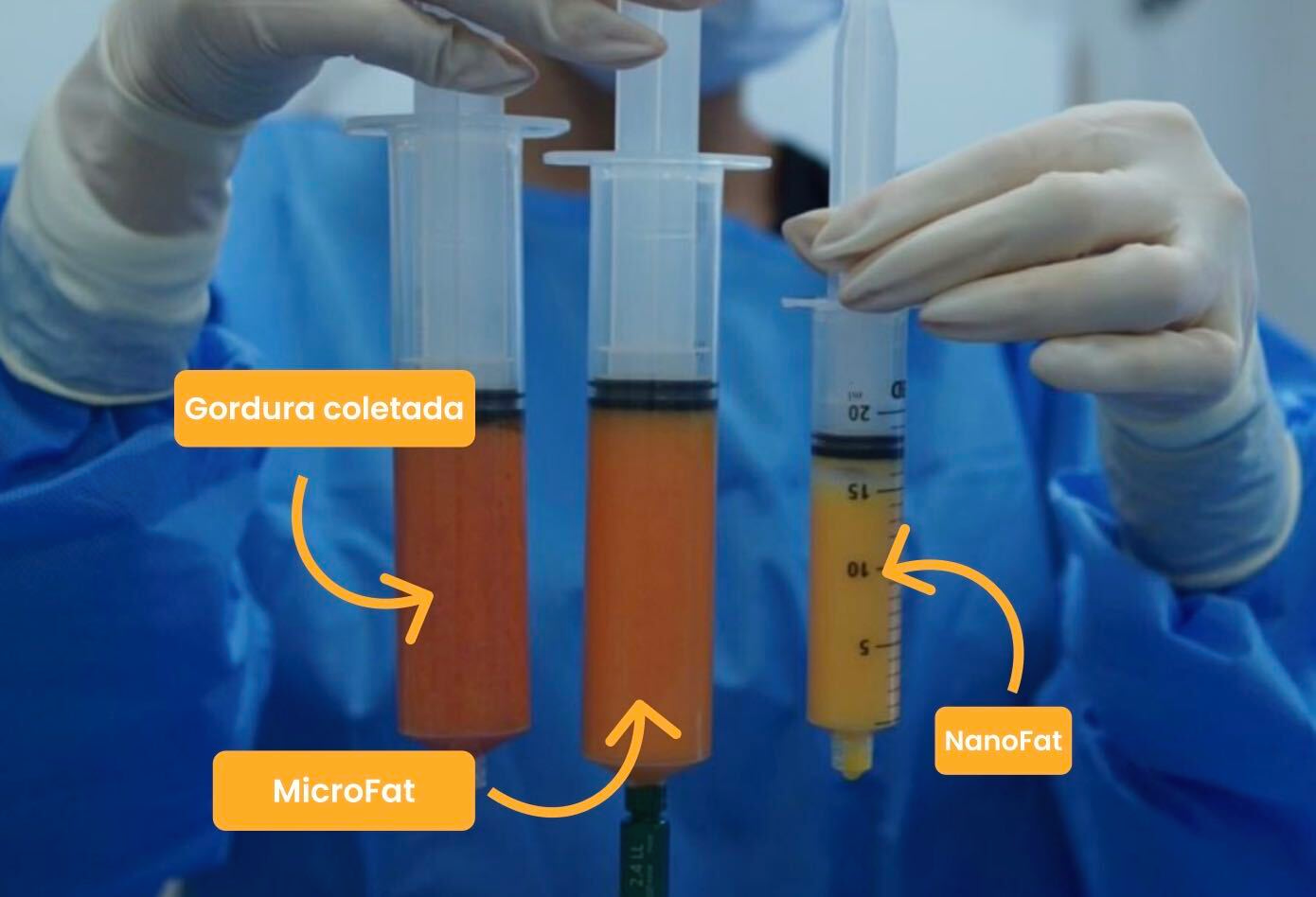 Diferenças entre Gordura coletada, MicroFat e NanoFat